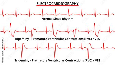 ECG vs. 2.